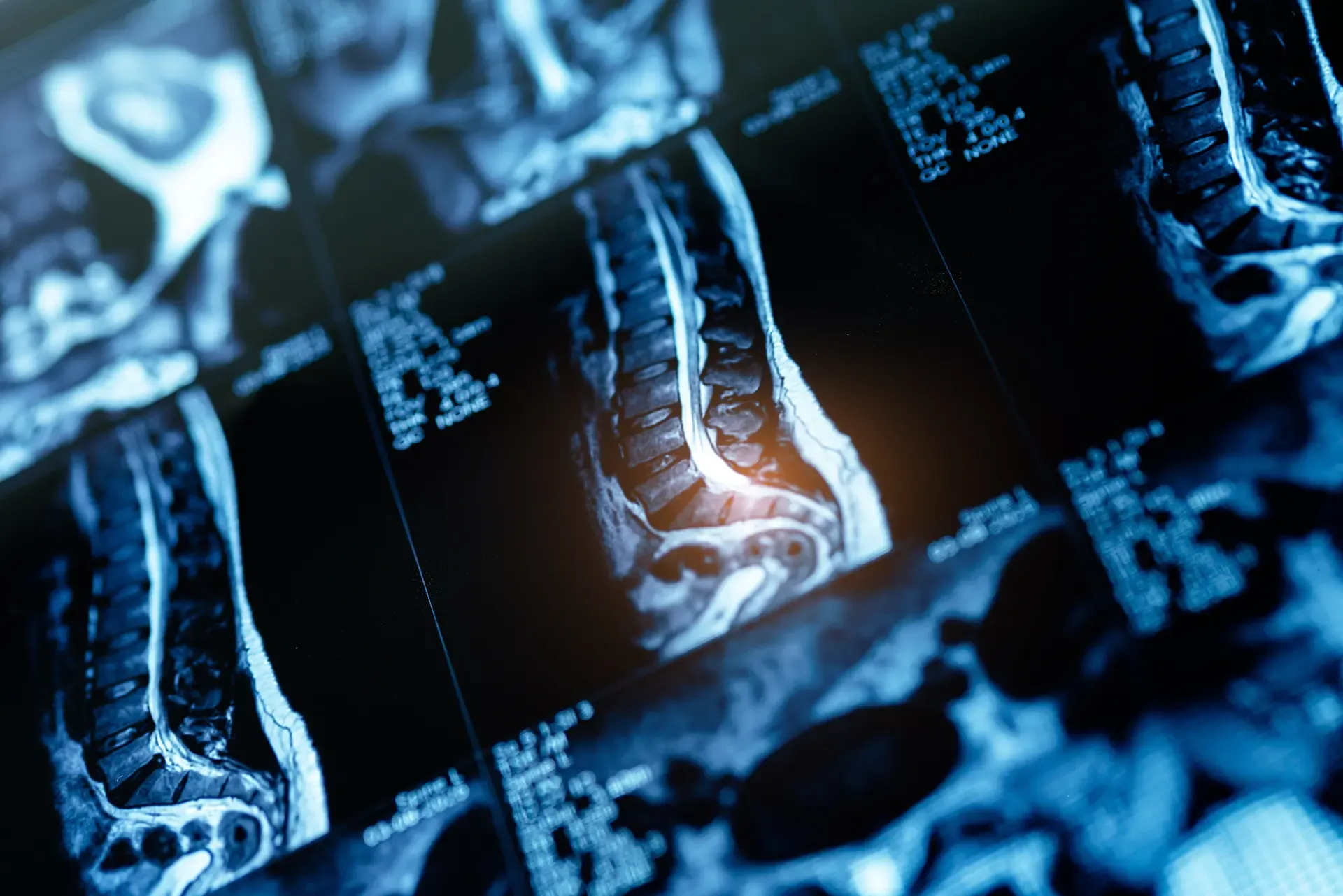 Price Spinal Cord Injuries Car Crashes Price Spinal Cord Injuries Car Crashes