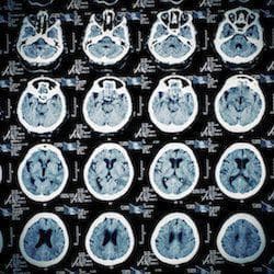 Traumatic Brain Injuries | Chicago Auto Accident Lawyer Chicago auto accident lawyer, Chicago car accident attorneys, traumatic brain injuries, blunt force trauma, head injuries, loss of consciousness, temporary amnesia